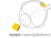 How eye works :: myopia :: near-sightedness