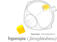 How eye works :: hyperopia :: farsigbtedness